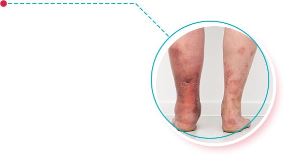 Elephantiasis