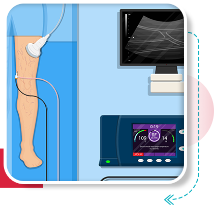 Ultrasound guided foam sclerotherapy in Vijayawada